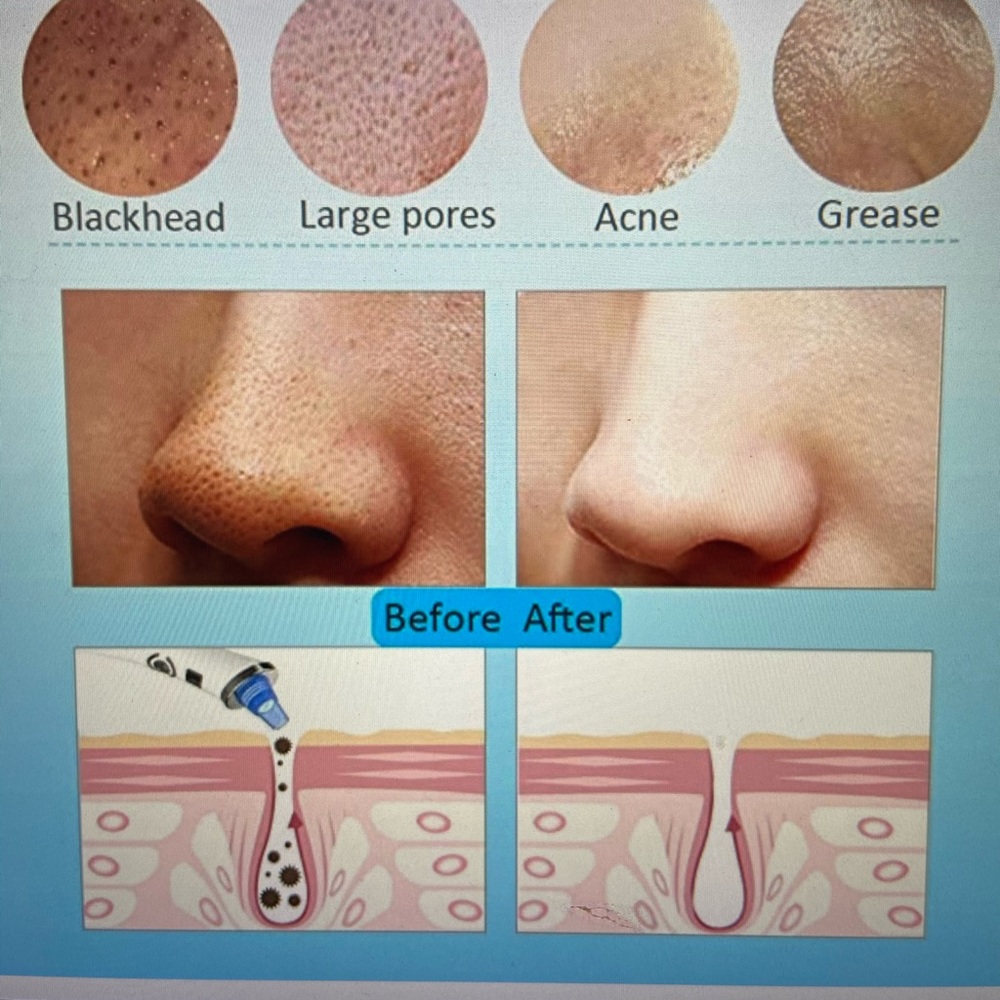 Bleakhead remover
